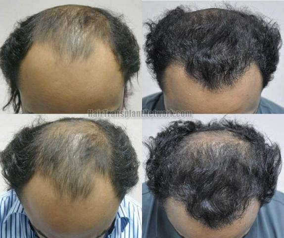 Before and after hair transplant procedure images