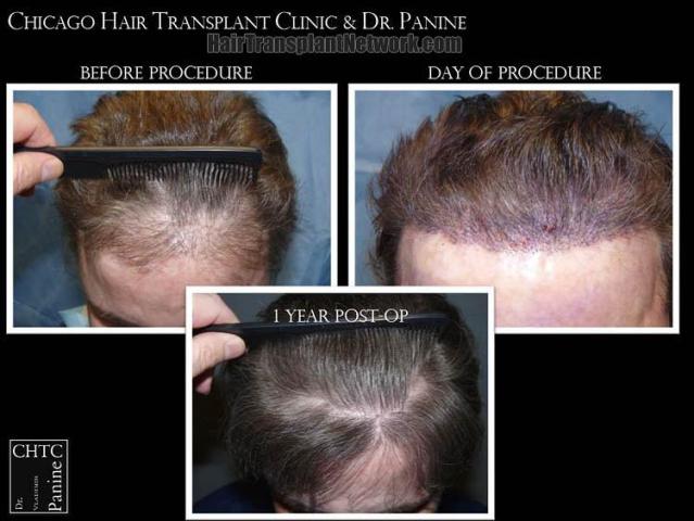 Hair transplantation surgery before and after photos