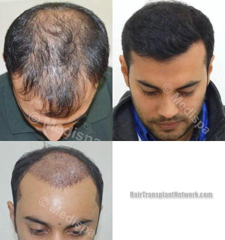 Hair restoration procedure before and after photo results