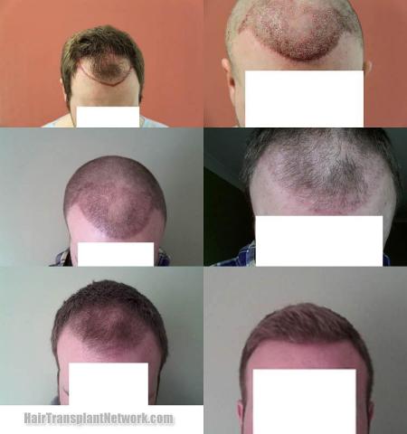 Hair restoration procedure before and after results