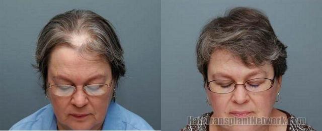 Female hair restoration patient - Front results