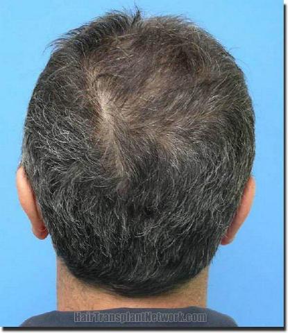 Hair restoration procedure results