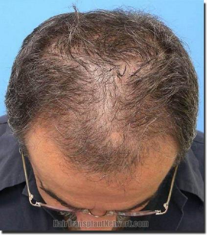 Hair restoration procedure results