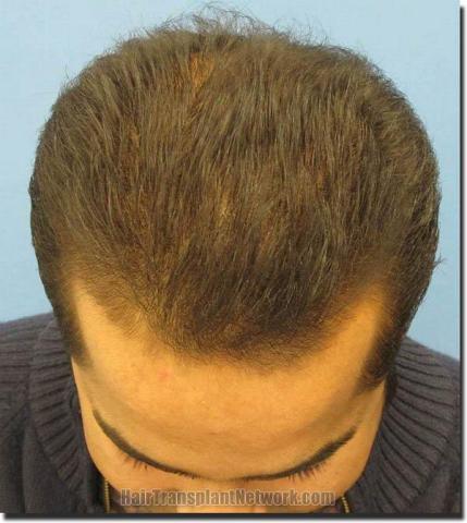 Hair restoration procedure results