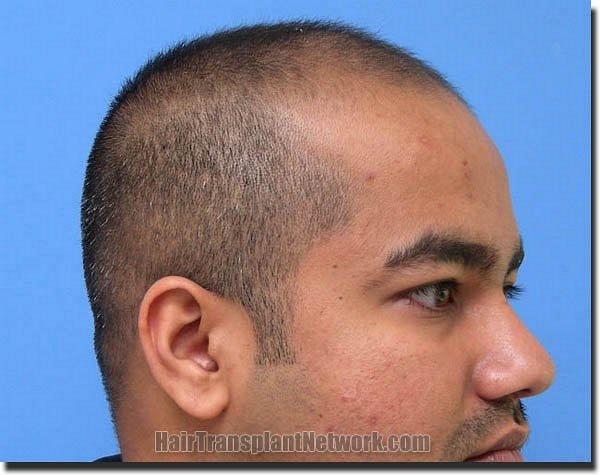 Hair restoration procedure results