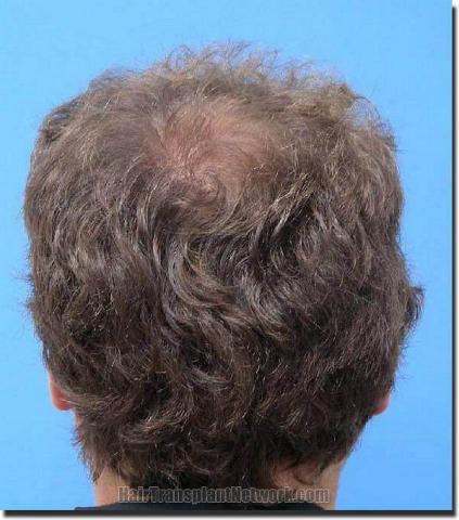 Hair restoration procedure results