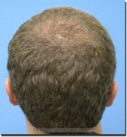 Hair restoration procedure results