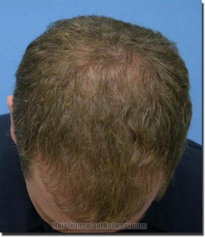 Hair restoration procedure results