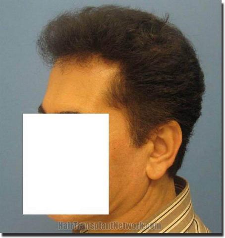 Hair restoration procedure results