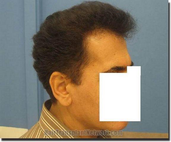 Hair restoration procedure results