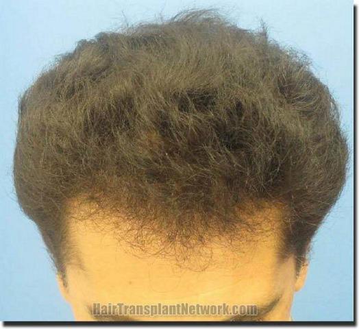 Hair restoration procedure results