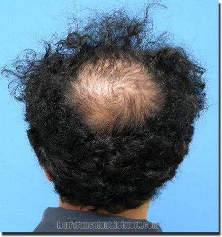 Hair restoration procedure results