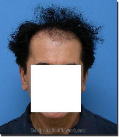 Hair restoration procedure results