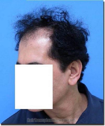 Hair restoration procedure results