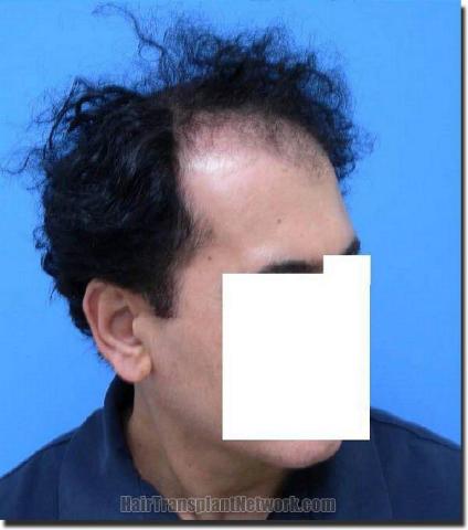 Hair restoration procedure results