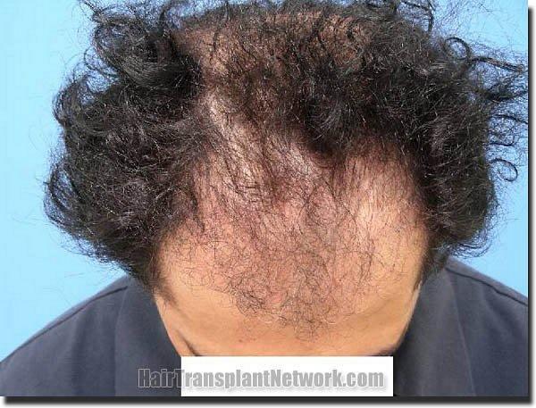 Hair restoration procedure results