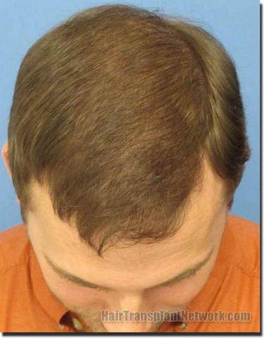 Hair restoration procedure results