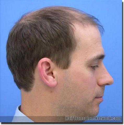 Hair restoration procedure results