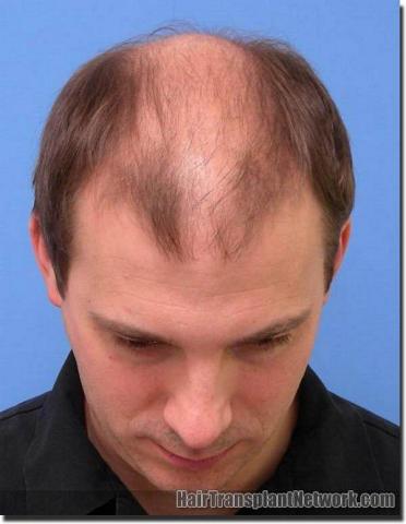 Hair restoration procedure results