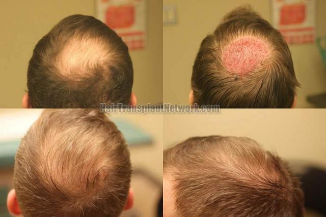 Hair restoration procedure before and after results