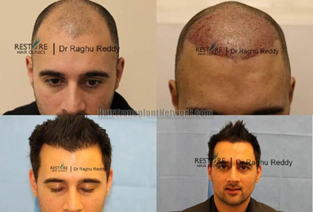 Hair restoration procedure before and after results