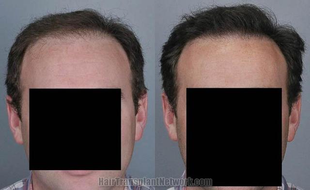 Hair restoration procedure before and after pictures