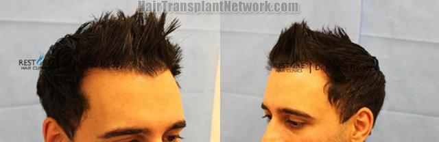 Hair transplantation surgery before and after images