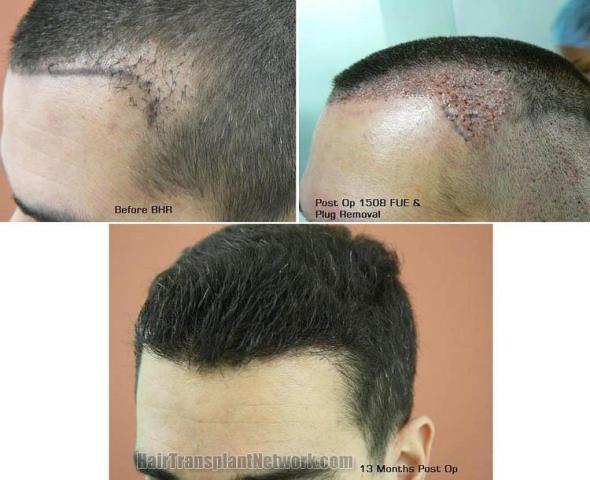 Hair transplantation surgery before and after photos