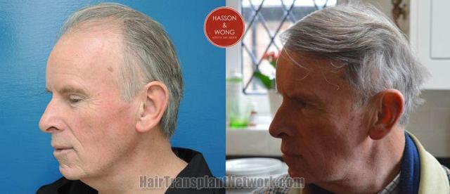 Hair transplantation surgery before and after images