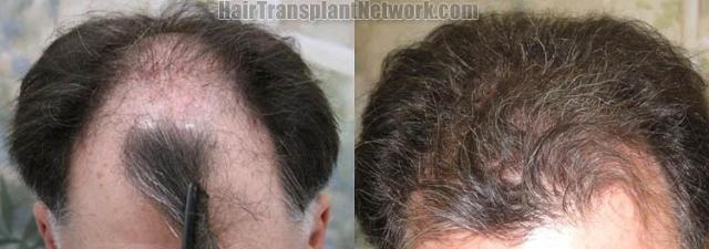 op view - Before and after surgical hair replacement