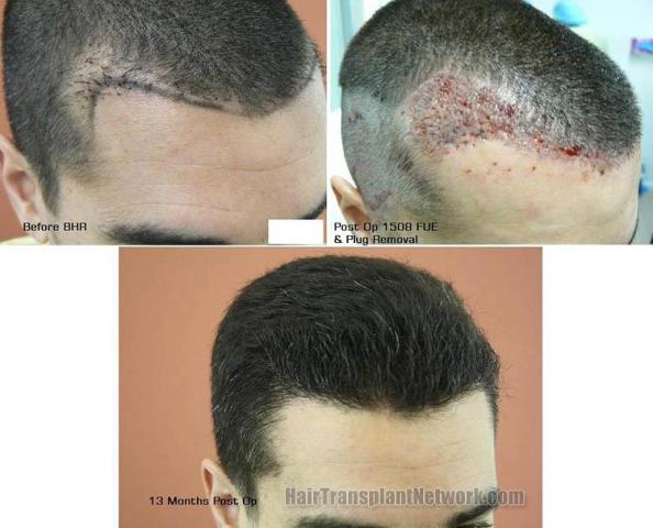 Hair restoration procedure before and after results