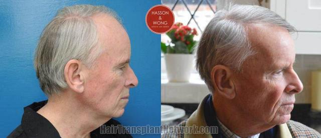 Hair transplantation surgery before and after pictures