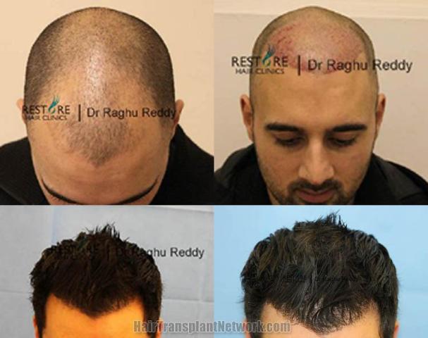 Hair transplantation surgery before and after photos