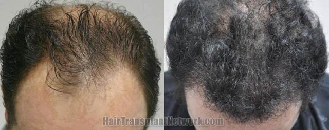 Top view - Before and after surgical hair replacement