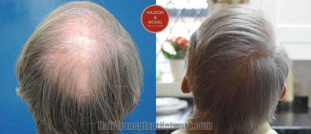 Hair restoration procedure before and after pictures