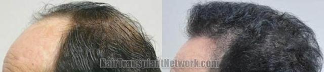 Hair transplantation surgery before and after pictures