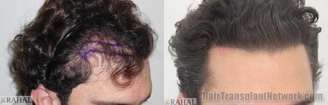 Hair transplantation surgery before and after photos