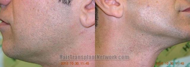 Hair restoration procedure before and after pictures