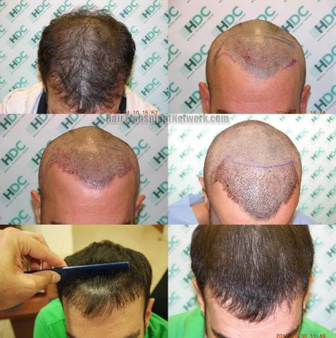 Hair restoration procedure before and after results