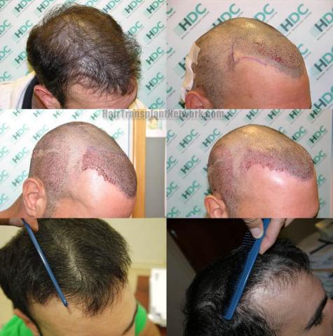 Hair transplantation surgery before and after photos