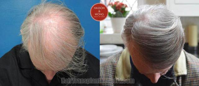 Hair transplantation surgery before and after photos