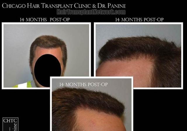 Hair transplantation surgery before and after photos