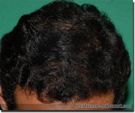 Hair restoration procedure results