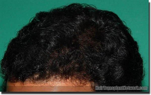 Hair restoration procedure results