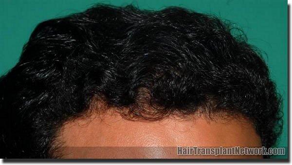 Hair restoration procedure results