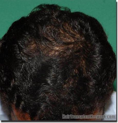 Hair restoration procedure results