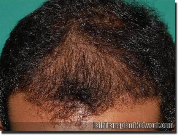 Hair restoration procedure results