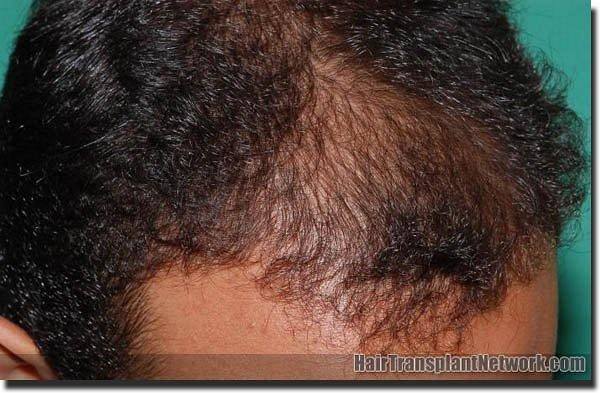 Hair restoration procedure results