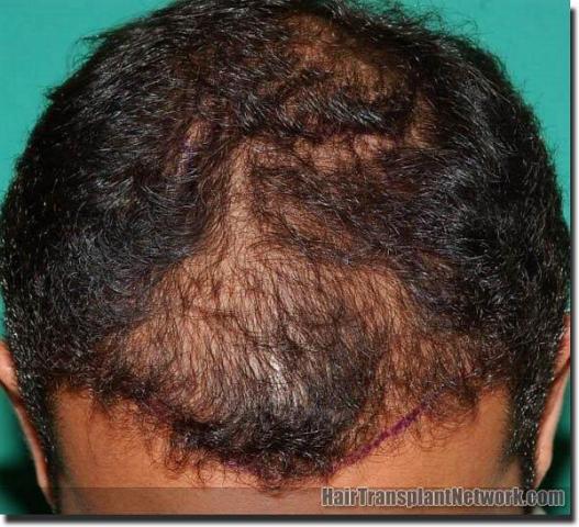 Hair restoration procedure results