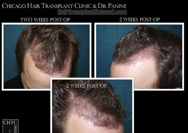 Hair restoration surgery before and after images